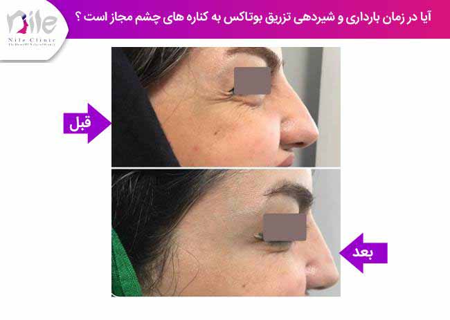 آیا در زمان بارداری و شیردهی تزریق بوتاکس به کناره های چشم مجاز است ؟