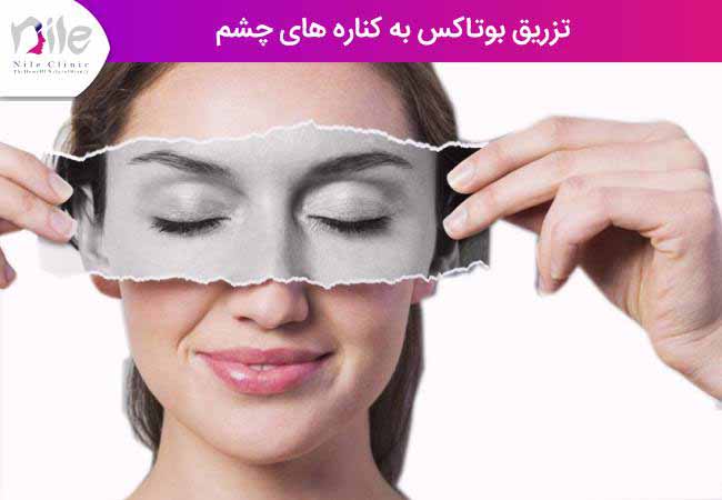 تزریق بوتاکس به کناره های چشم
