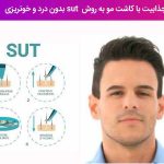 هزینه کاشت مو به روش SUT