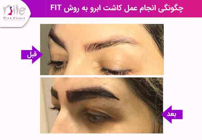 چگونگی انجام عمل کاشت ابرو به روش fit