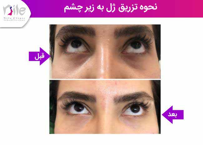 نحوه تزریق ژل به زیر چشم