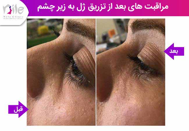 مراقبت های بعد از تزریق ژل به زیر چشم