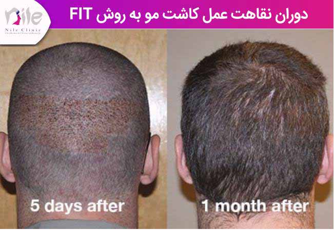 دوران نقاهت عمل کاشت مو به روش fit