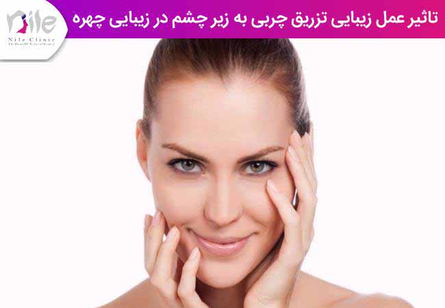 تاثیر عمل زیبایی تزریق چربی به زیر چشم در زیبایی چهره