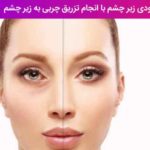 اصلاح گودی زیر چشم با انجام تزریق چربی به زیر چشم