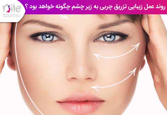 روند عمل زیبایی تزریق چربی به زیر چشم چگونه خواهد بود ؟