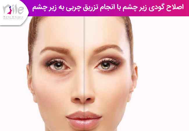 اصلاح گودی زیر چشم با انجام تزریق چربی به زیر چشم