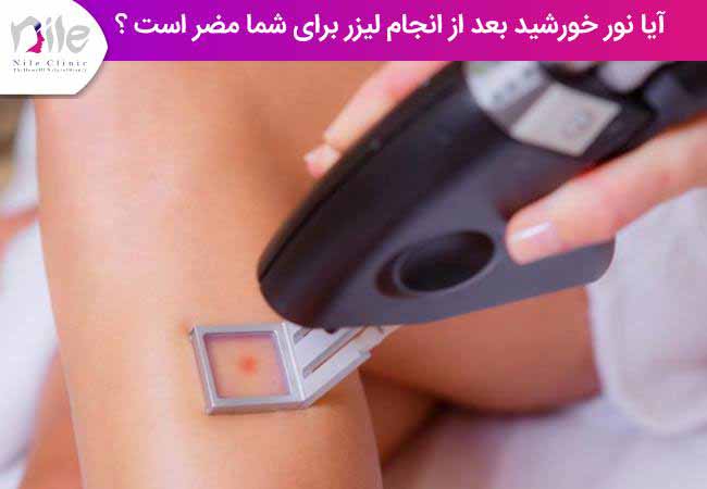 آیا نور خورشید بعد از انجام لیزر برای شما مضر است ؟
