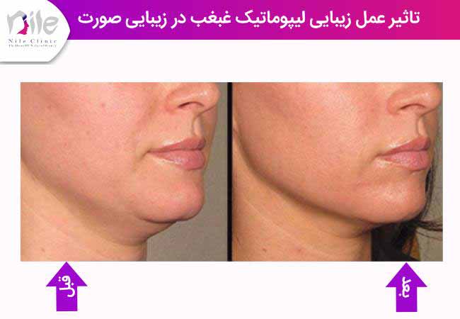 تاثیر عمل زیبایی لیپوماتیک غبغب در زیبایی صورت