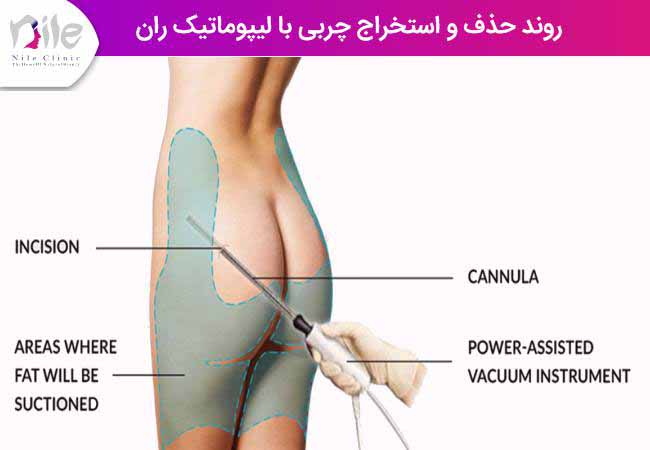 روند حذف و استخراج چربی با لیپوماتیک ران