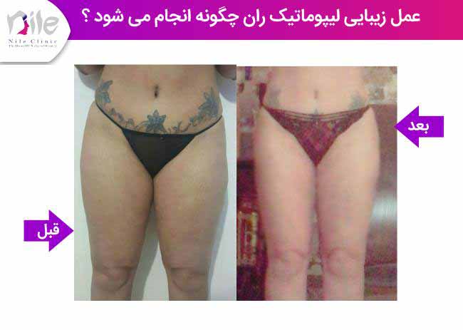 عمل زیبایی لیپوماتیک ران چگونه انجام می شود ؟