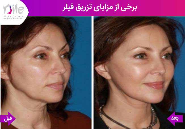 برخی از مزایای تزریق فیلر