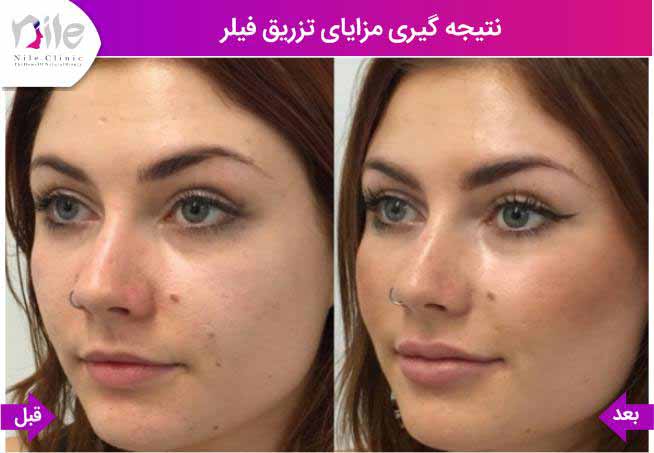 نتیجه گبری مزایای تزریق فیلر