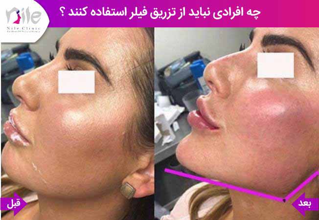 چه افرادی نباید از تزریق فیلر استفاده کنند ؟