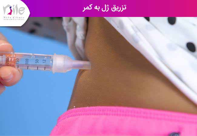 تزریق ژل به کمر
