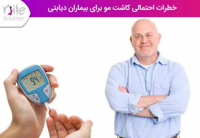 خطرات احتمالی کاشت مو برای بیماران دیابتی