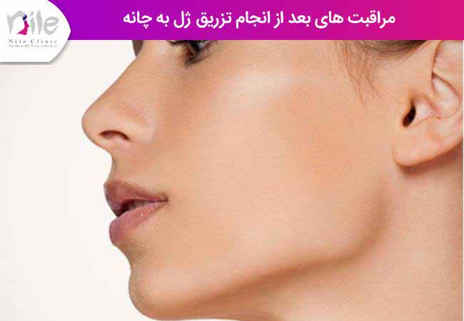 مراقبت های بعد از انجام تزریق ژل به چانه