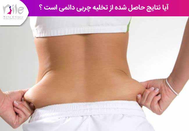 آیا نتایج حاصل شده از عمل زیبایی لیپوماتیک دائمی است ؟