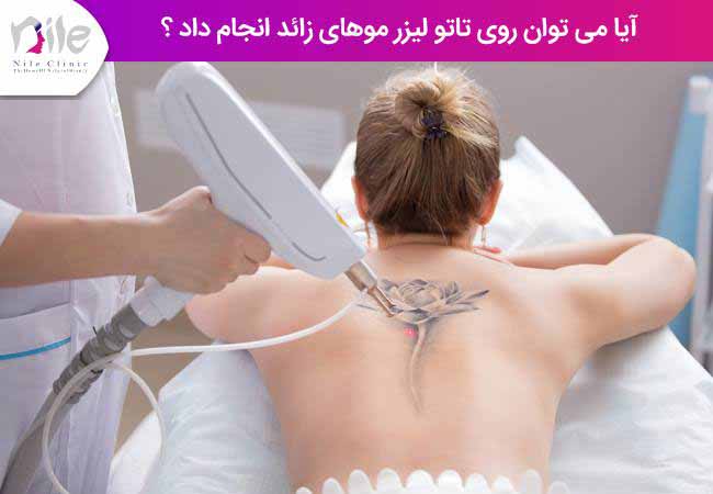 آیا می توان روی تاتو لیزر موهای زائد انجام داد ؟