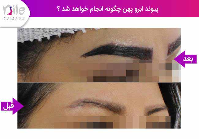 پیوند ابرو پهن چگونه انجام خواهد شد؟