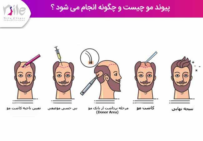 پیوند مو چیست و چگونه انجام می شود