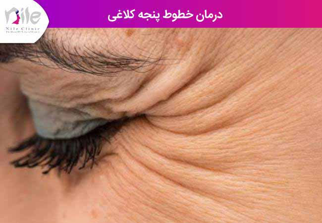 درمان خطوط پنجه کلاغی