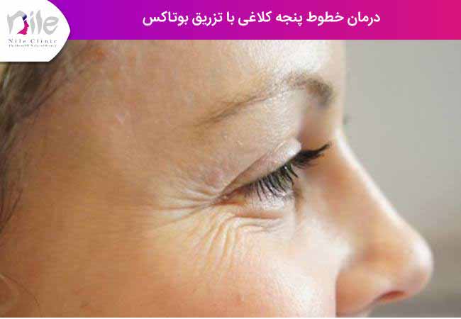 درمان خطوط پنجه کلاغی با تزریق بوتاکس