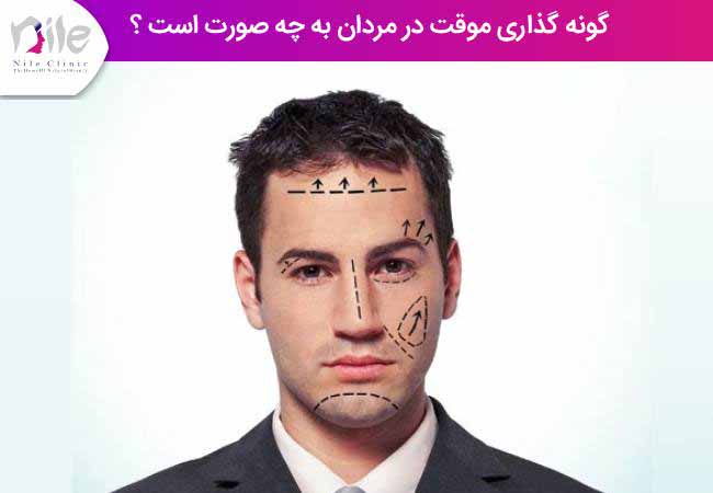 گونه گذاری موقت در مردان به چه صورت است ؟