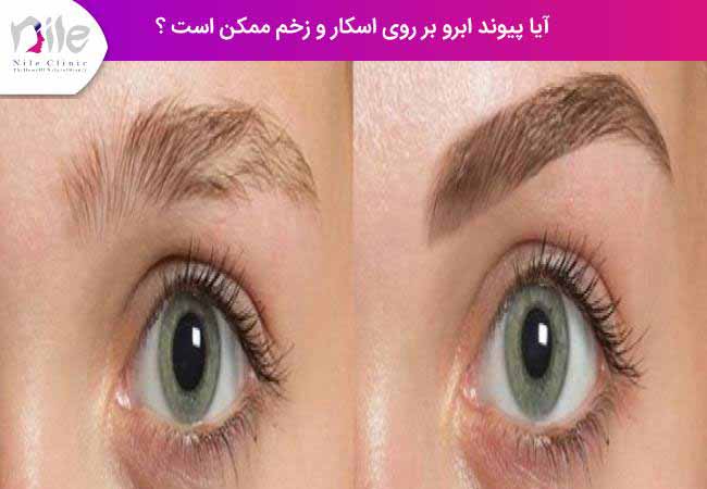 آیا پیوند ابرو بر روی اسکار و زخم ممکن است ؟