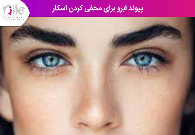 پیوند ابرو برای مخفی کردن اسکار