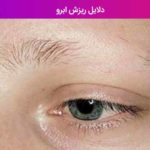 دلایل ریزش ابرو