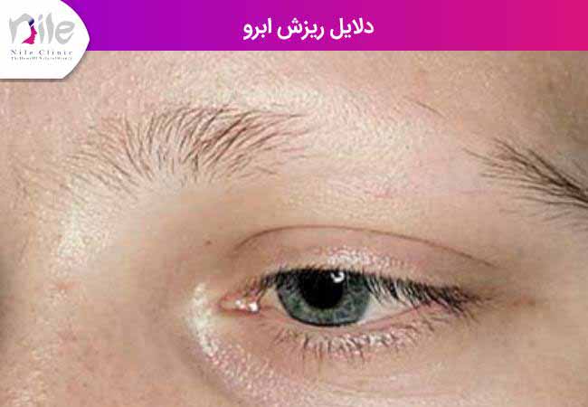 دلایل ریزش ابرو