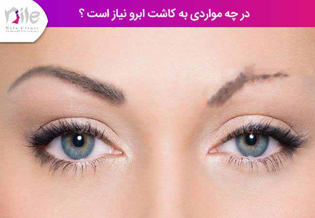 در چه مواردی به کاشت ابرو نیاز است ؟