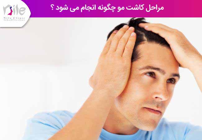مراحل کاشت مو چگونه انجام می شود ؟