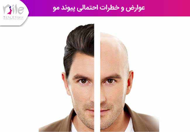 عوارض و خطرات احتمالی پیوند مو