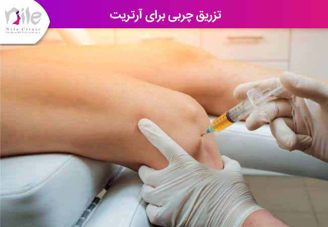 تزریق چربی برای آرتریت