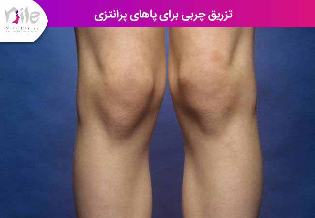تزریق چربی برای پاهای پرانتزی