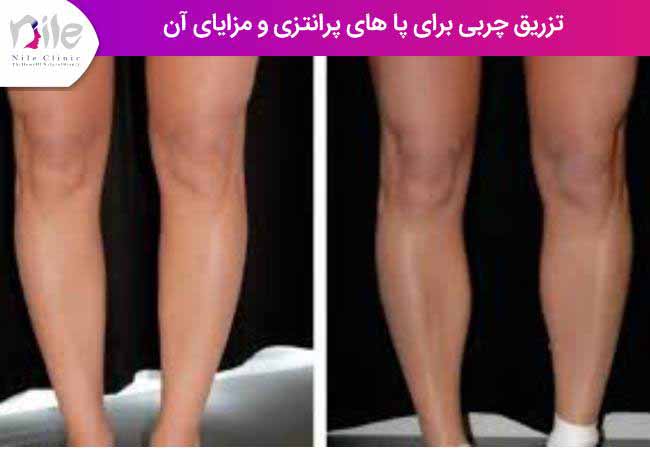 تزریق چربی برای پاهای پرانتزی و مزایای آن
