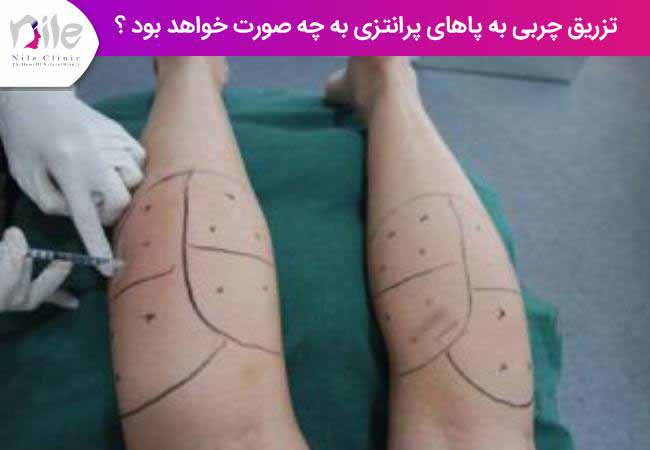 تزریق چربی به پاهای پرانتزی به چه صورت خواهد بود ؟
