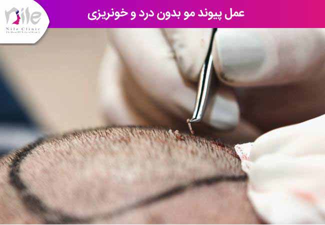 عمل پیوند مو بدون درد و خونریزی