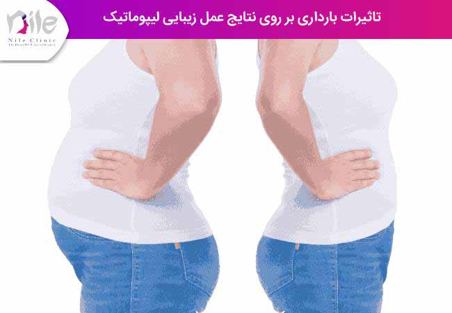 تاثیرات بارداری بر روی نتایج عمل تخلیه چربی