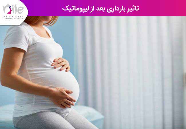تاثیر بارداری بعد از لیپوماتیک