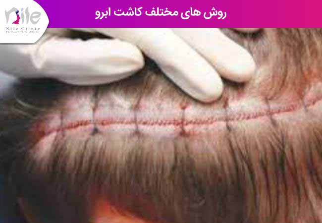 روش های مختلف کاشت ابرو