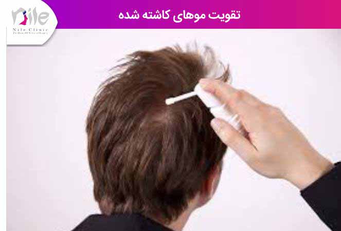 تقویت موهای کاشته شده