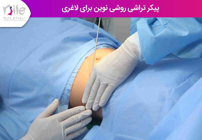پیکر تراشی روشی نوین برای لاغری