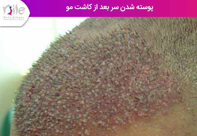 پوسته شدن سر بعد از کاشت مو