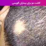 کاشت مو برای بیماران آلوپسی