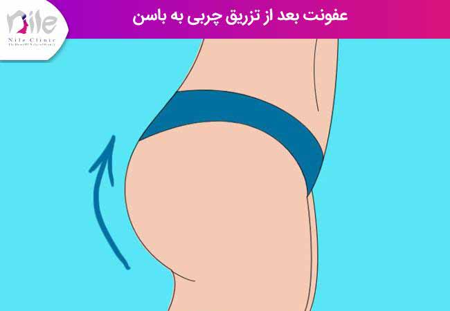 عفونت بعد از تزریق چربی به باسن