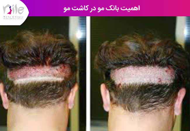 اهمیت بانک مو در کاشت مو