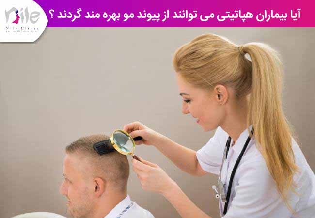 آیا بیماران هپاتیتی می توانند از پیوند مو بهره گیرند